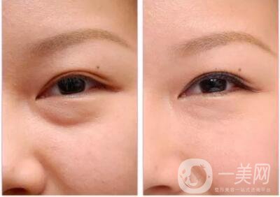 超聲波祛眼袋術(shù)前準(zhǔn)備事項