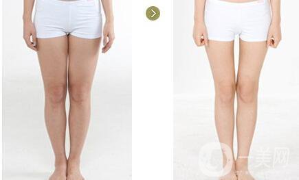 小腿吸脂手術之后多久會瘦