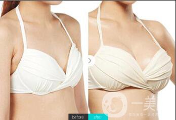假體豐胸之后的手感好不好