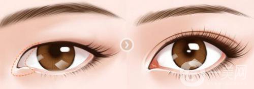 開(kāi)眼角會(huì)疤痕增生嗎 術(shù)后應(yīng)該怎么護(hù)理