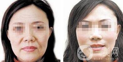 電波拉皮除皺好嗎？*果到底怎么樣