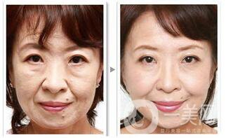 電波拉皮的副作用具體有哪些