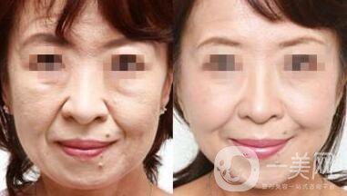 北京熱瑪吉一次多少錢