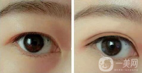 北京割雙眼皮的價(jià)格是多少錢