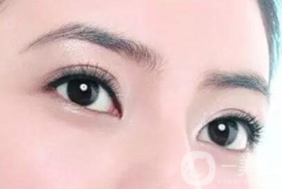 割雙眼皮痕跡多久消失？