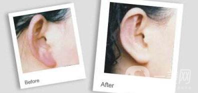 玻尿酸豐耳垂,玻尿酸豐耳垂多少錢,上海玻尿酸豐耳垂多少錢