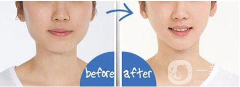 吸脂去雙下巴,吸脂去雙下巴*果,吸脂去雙下巴術(shù)后護理