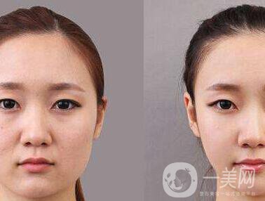 顴骨手術(shù)多長時間恢復(fù)？