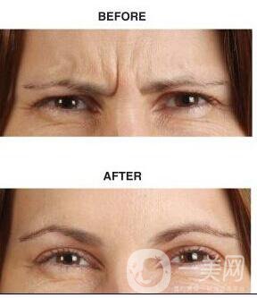 去除眉間皺紋,去除眉間皺紋價格,北京去除眉間皺紋價格