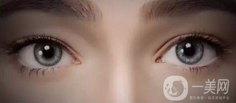 開眼角手術(shù)價(jià)格是多少？