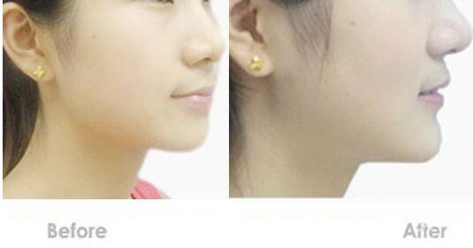 墊下巴,墊下巴價格,廣東墊下巴價格