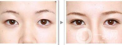 三點(diǎn)割雙眼皮是*的么