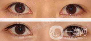 三點(diǎn)割雙眼皮是*的么