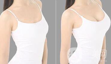 長沙自體脂肪隆胸手術(shù)多少錢