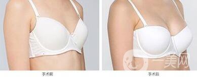 長沙自體脂肪隆胸手術(shù)多少錢