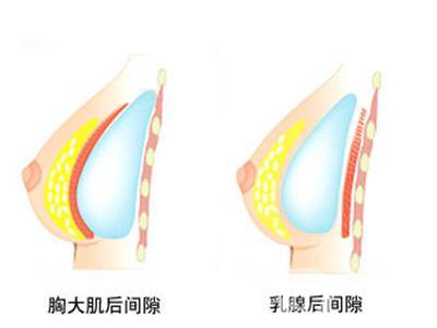 上海假體隆胸的價錢一般是多少