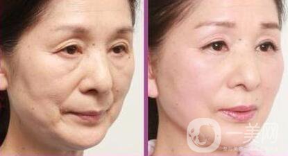 冰點(diǎn)拉皮*果怎么樣？