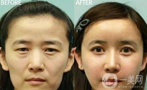 冰點(diǎn)拉皮*果怎么樣？