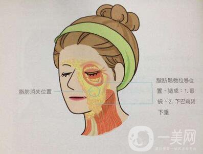 電波拉皮除皺*果好嗎？