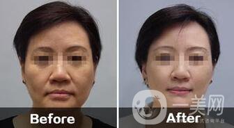南京做電波拉皮手術價錢多少