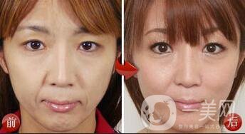 南京做電波拉皮手術價錢多少