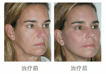 上海做美容拉皮手術(shù)的費用