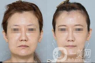 深圳埋線臉部提升價格多少