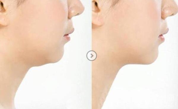 長雙下巴怎么辦？減雙下巴的方法有哪些