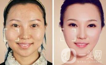 蘇州做顴骨手術(shù)多少錢