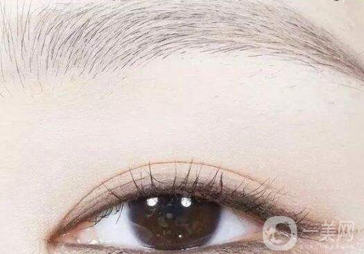 割雙眼皮術(shù),雙眼皮術(shù)后注意事項(xiàng)