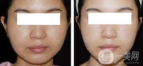 光纖溶脂瘦臉*果保持多久