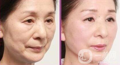 拉皮怎樣做？拉皮*果有哪些？