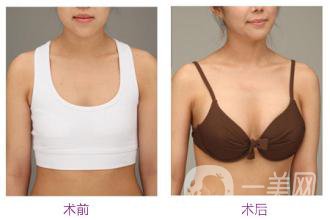 北京假體豐胸的害處主要有什么