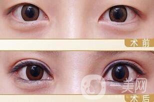 割雙眼皮冷敷作用是什么