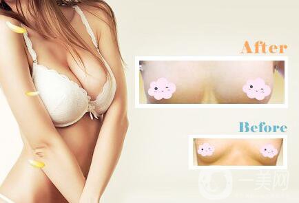 妙桃假體隆胸好嗎？