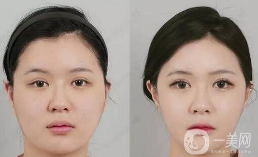 面部拉皮哪種方法更好？