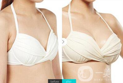 自體脂肪填充隆胸*果怎么樣