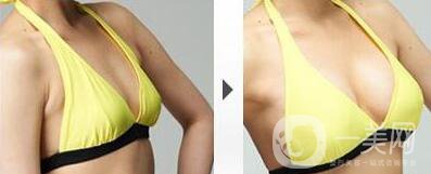 蘇州假體隆胸一般多少錢(qián)