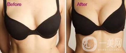 蘇州假體隆胸一般多少錢(qián)