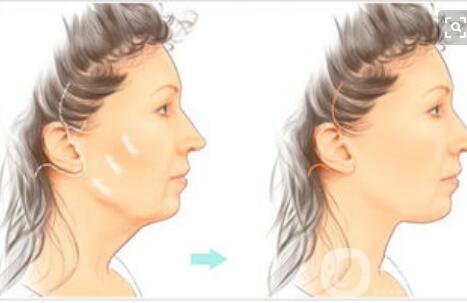 拉皮,拉皮風(fēng)險