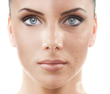 電波拉皮,電波拉皮多少錢,北京電波拉皮多少錢