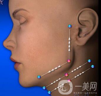 廣州電波拉皮除皺手術(shù)一般價(jià)錢(qián)