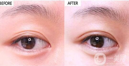 割雙眼皮,割雙眼皮價(jià)格