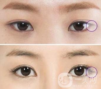 開眼角手術(shù)的風險主要有哪些