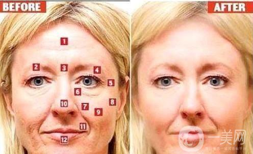 極線(xiàn)音波拉皮手術(shù)的價(jià)格一般是多少