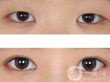 開眼角眼睛變化大嗎？