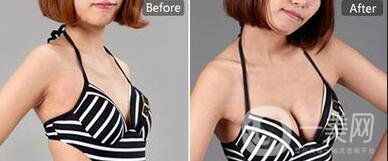 假體豐胸水滴形適合哪些人