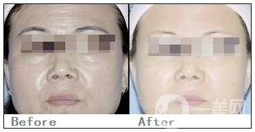 拉皮術(shù)保持多久 重回青春面容