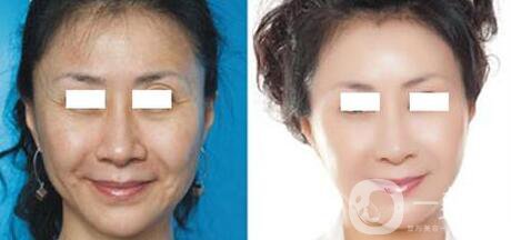 拉皮術(shù)保持多久 重回青春面容