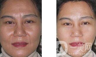 電波拉皮有用嗎  除皺緊膚一步到位